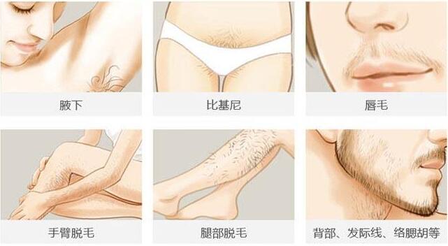激光脫毛要多少錢？全面解析費用因素，激光脫毛費用全面解析，價格因素一網打盡