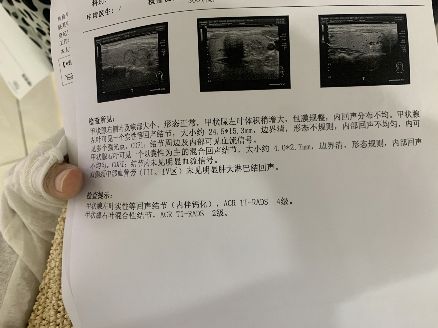 甲狀腺結(jié)節(jié)大小多少mm以上建議手術(shù)？全面解讀甲狀腺結(jié)節(jié)手術(shù)標(biāo)準(zhǔn)與注意事項，甲狀腺結(jié)節(jié)手術(shù)標(biāo)準(zhǔn)與注意事項，何時需手術(shù)？甲狀腺結(jié)節(jié)大小臨界點解析