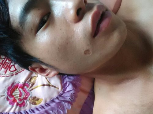 除疤費用一般多少錢——全面解析除疤費用因素與價格范圍，全面解析，除疤費用因素與價格范圍，了解除疤需要多少錢？