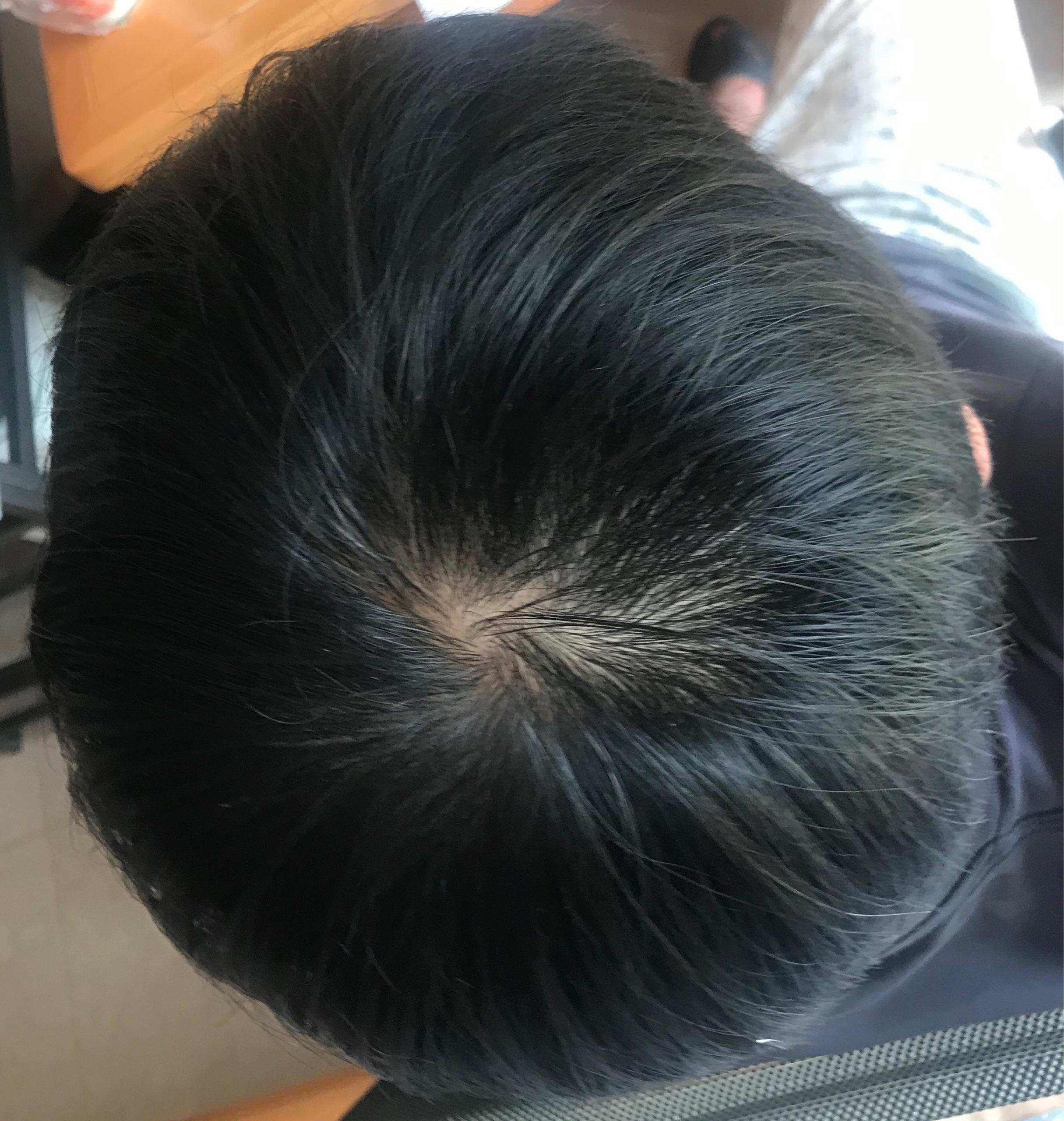 頭頂頭發(fā)稀疏怎么恢復(fù)，原因、治療與日常護(hù)理全解析，頭頂頭發(fā)稀疏，恢復(fù)方法、原因解析與日常護(hù)理全攻略