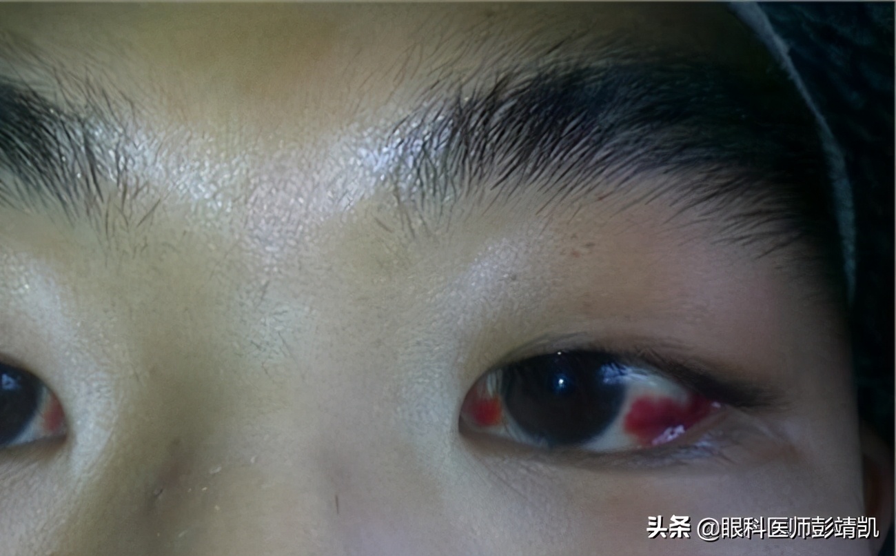 眼球發(fā)紅充血的原因及應對措施，眼球發(fā)紅充血，原因解析與應對策略