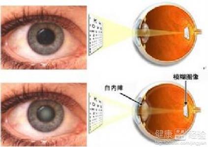 白內(nèi)障的早期癥狀及其識別，白內(nèi)障早期癥狀識別與預防